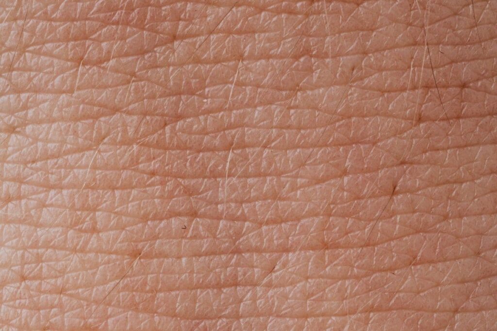 Treatment of Hives: Effective Remedies and Medications